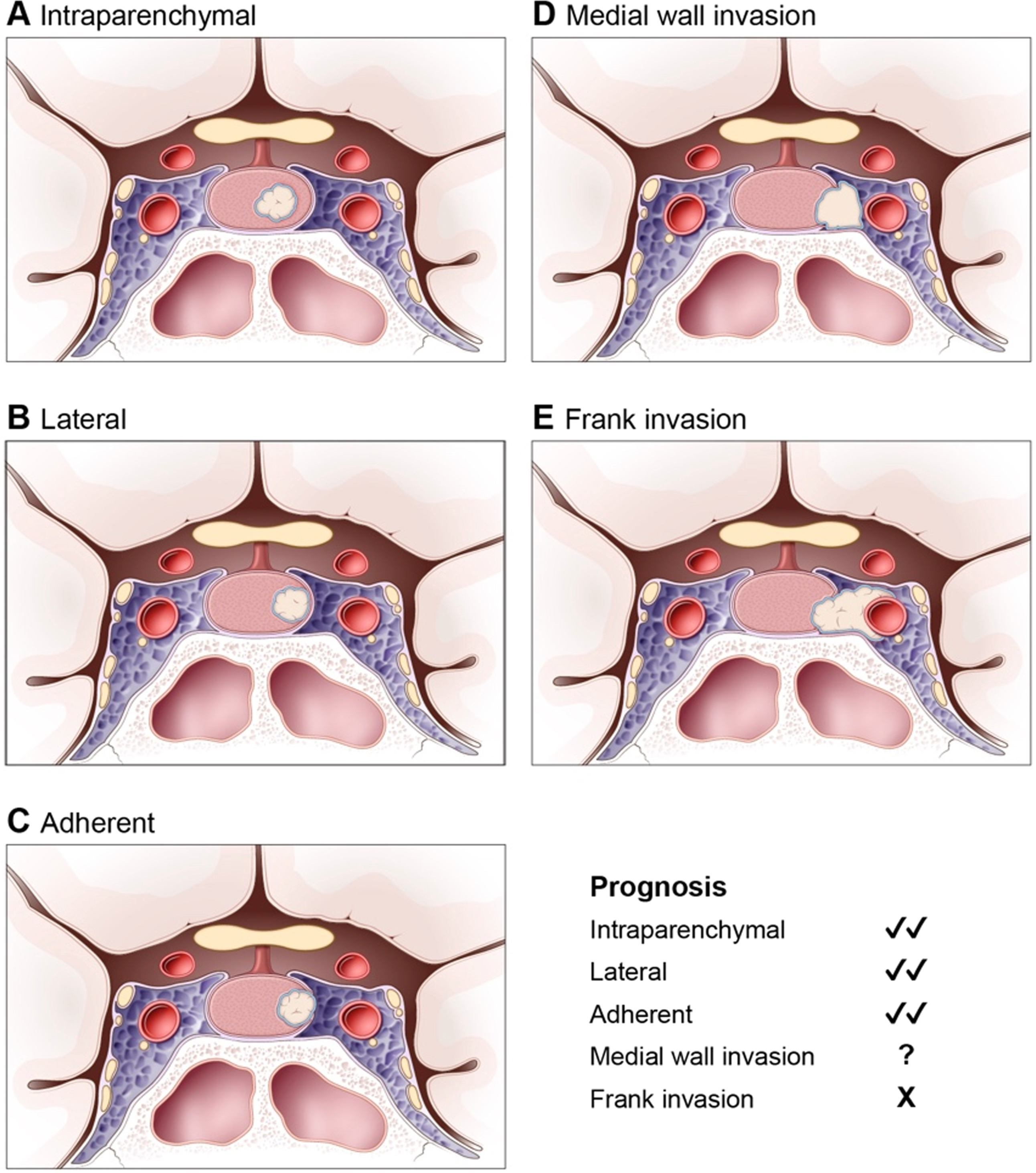 An illustration with panels A to E depicting tumour positions labelled Intraparencymal, Lateral, Adherent, Medial wall invasion, and Frank invasion, with a prognosis list.