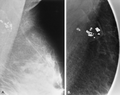 Anatomy of the Breast, Axilla, and Chest Wall