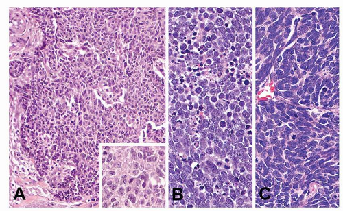 Neuroendocrine Tumors And Nonneoplastic Neuroendocrine Cell Changes ...