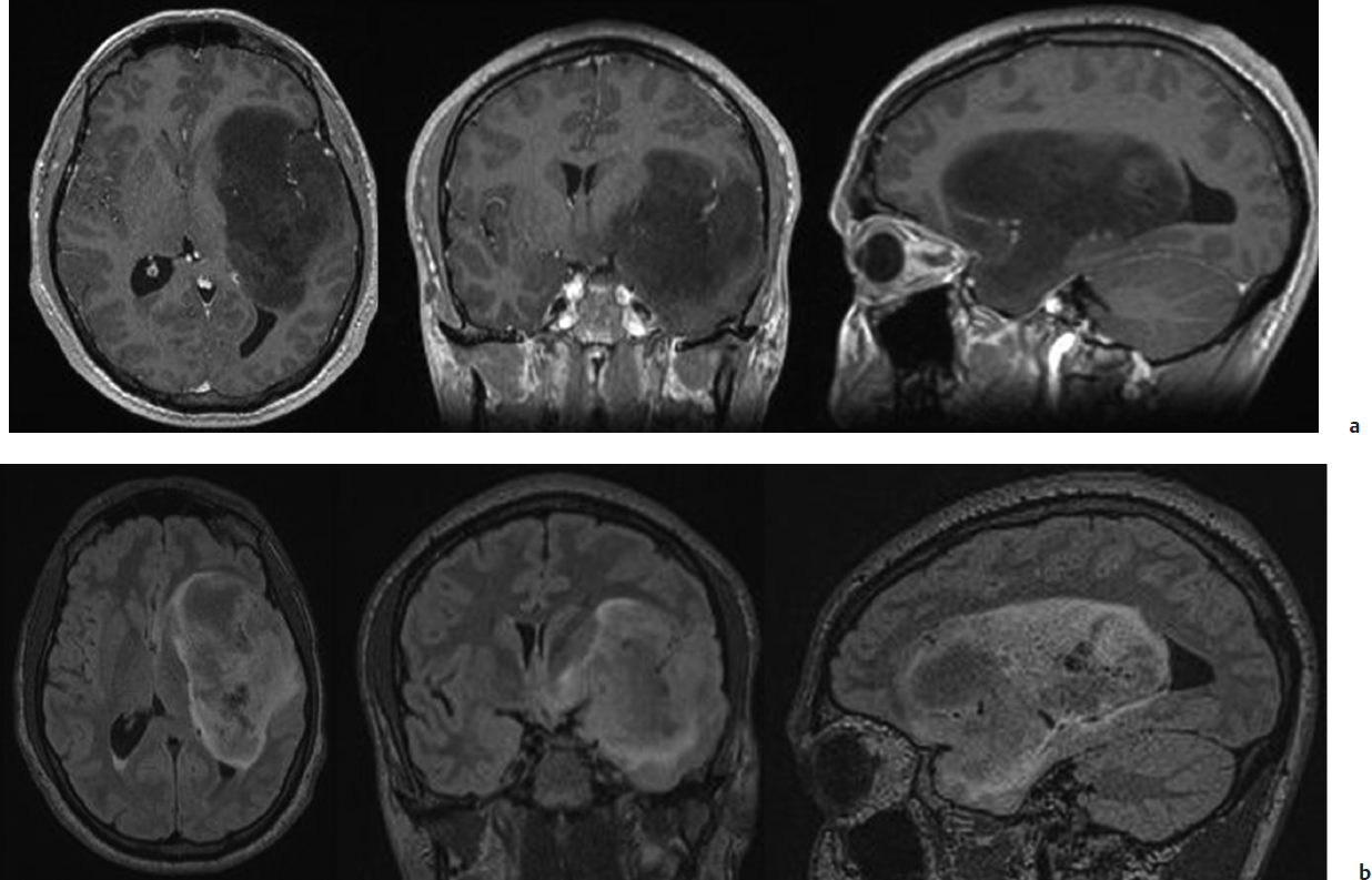 low-grade-gliomas-oncohema-key