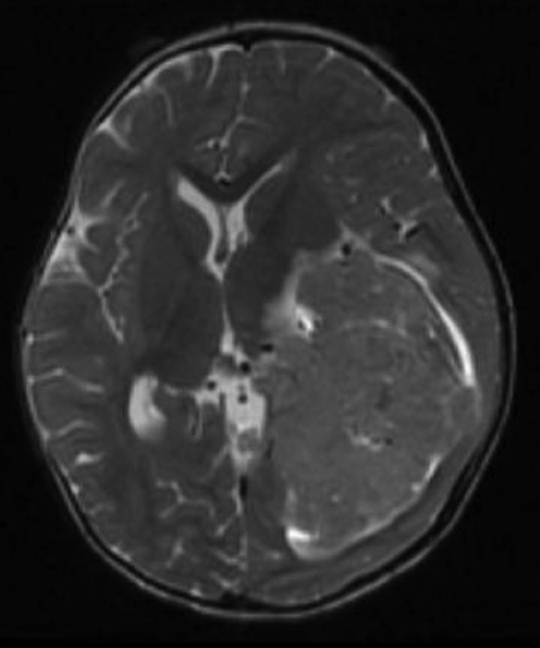 Pediatric Supratentorial Tumors Oncohema Key 2509