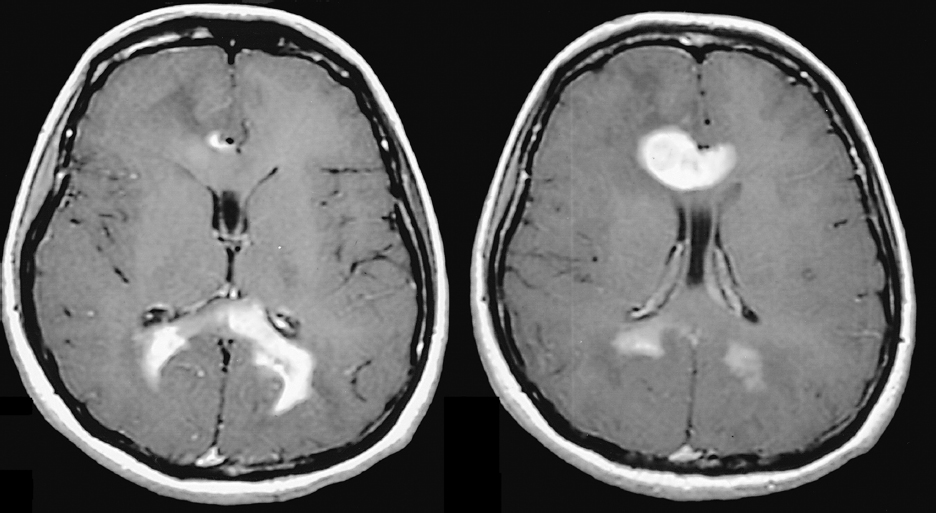 primary-central-nervous-system-lymphoma-oncohema-key