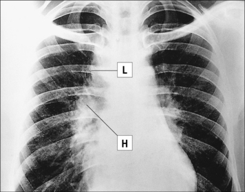 Hypersensitivity (Type IV) | Oncohema Key