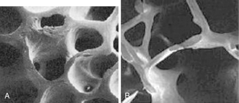 Osteoporosis | Oncohema Key