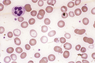 Blood cell morphology in health and disease | Oncohema Key