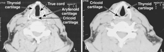 Cancer of the Larynx | Oncohema Key