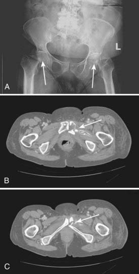 Cancer Of The Vulva | Oncohema Key