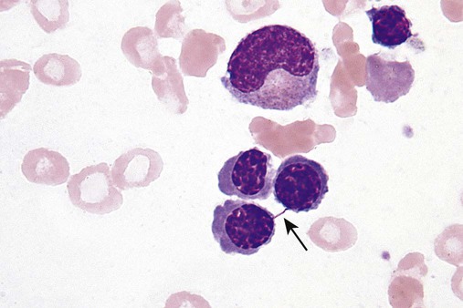 Bone Marrow Failure Oncohema Key