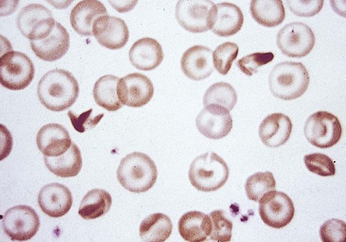 Intracellular RBC hemoglobin precipitates (Heinz bodies) in a patient