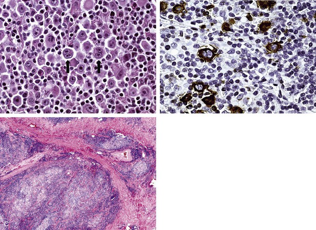 Mature Lymphoid Neoplasms | Oncohema Key