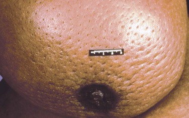 Breast skin- are these normal hair follicular? Or inflammatory breast  cancer dimples? : r/SkincareAddicts