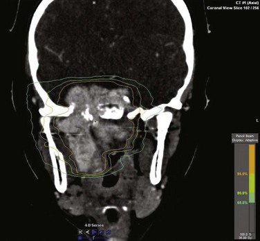 Nasopharynx Oncohema Key