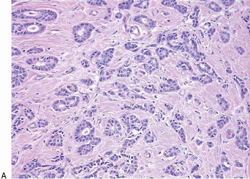 invasive ductal carcinoma histology