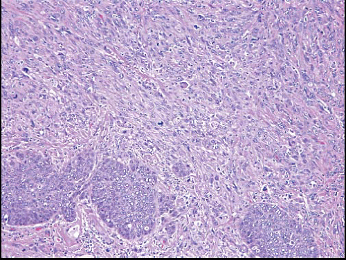 spindle cell carcinoma