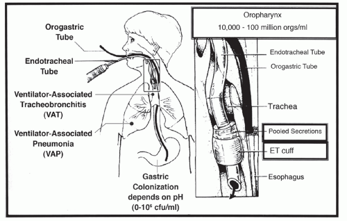 Pneumonia ventilator associated Ventilator Associated