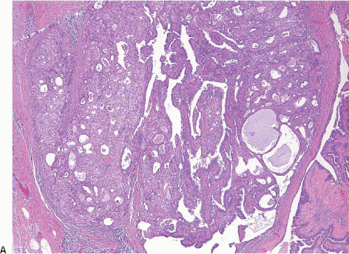 intraductalis papilloma dcis