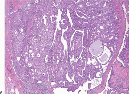 intraductalis papilloma dcis)