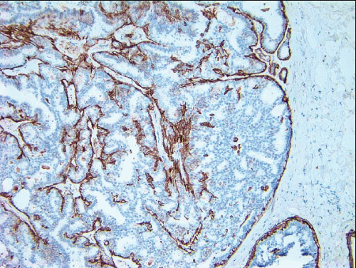 Papillary Lesions Oncohema Key