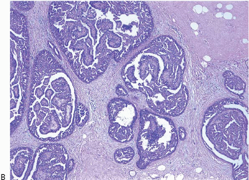 papillary lesion treatment