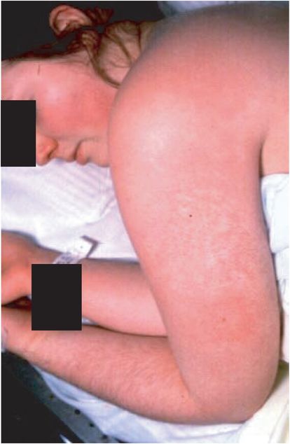 toxic shock syndrome skin rash