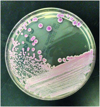 Candidiasis Oncohema Key