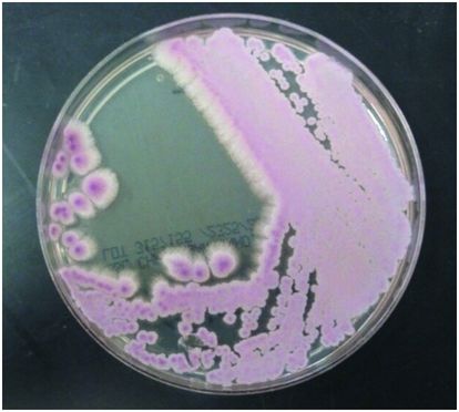 Candidiasis Oncohema Key