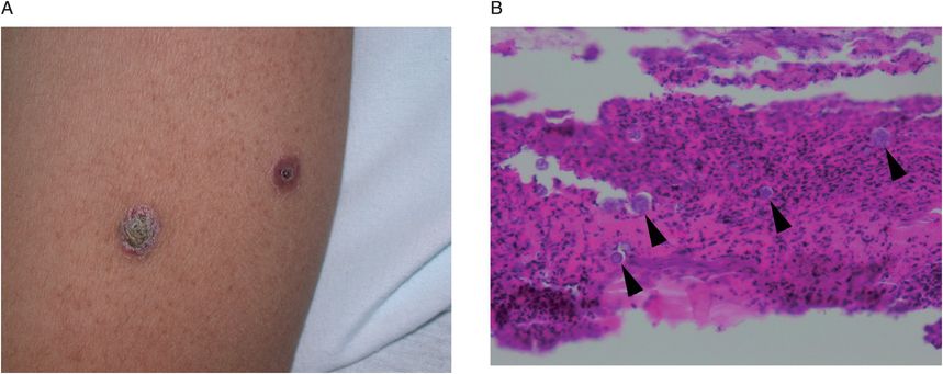 F UV bufotoxin coccidioidomycosis February hjjkk it hhggff