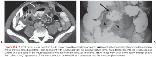 Cancer of the Small Bowel | Oncohema Key