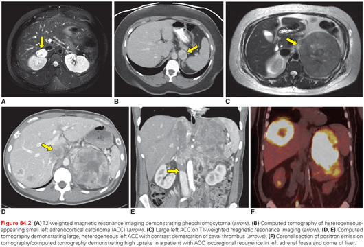 tumor that secretes adrenaline