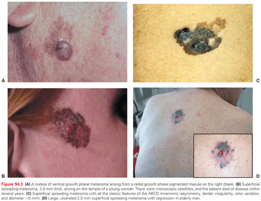 Cutaneous Melanoma | Oncohema Key