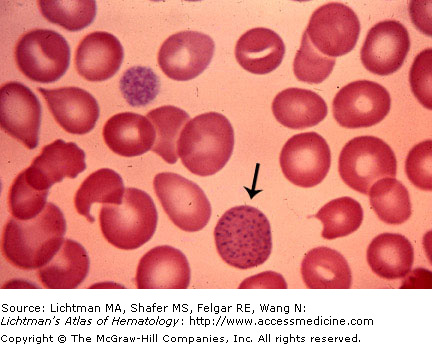 Blood Morphology - Ask Hematologist | Understand Hematology
