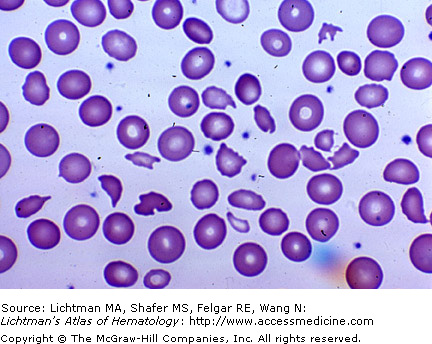 anemia with misshapen red blood cells