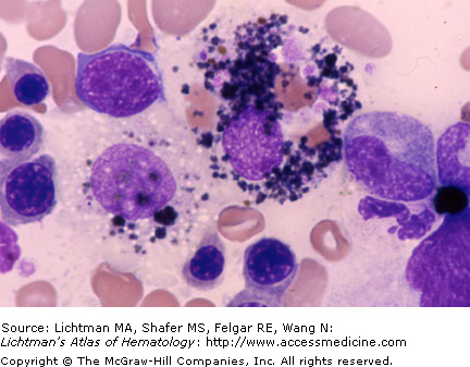 macrophage with hemosiderin