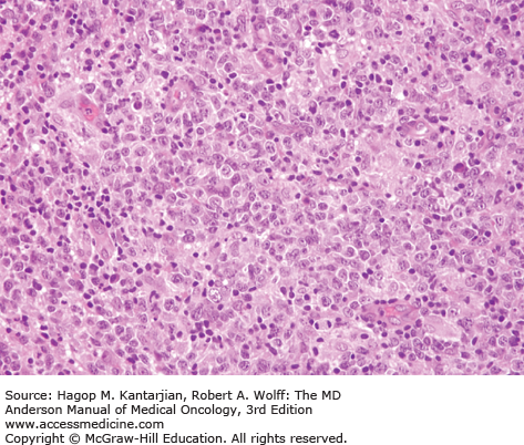 T-Cell Lymphomas | Oncohema Key