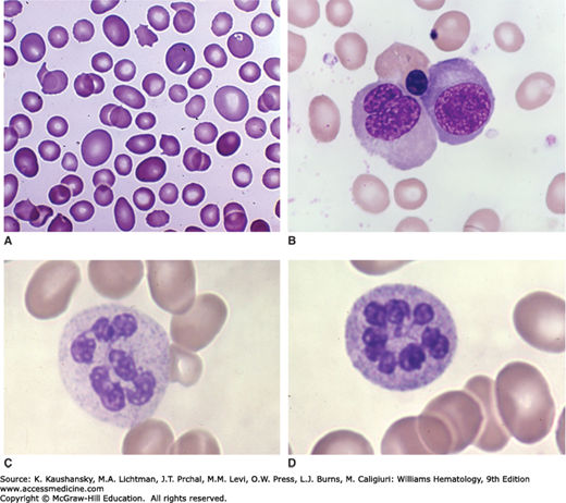 Folate, Cobalamin, and Megaloblastic Anemias | Oncohema Key