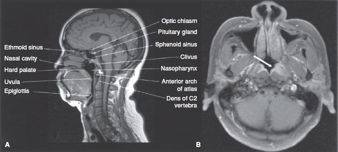 Nasopharynx Anatomy Radiology Anatomy Structure 7753