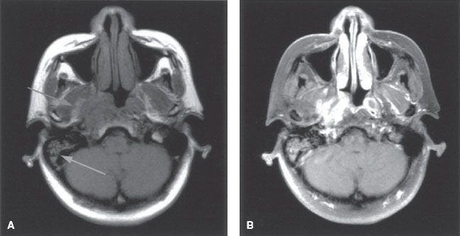 Nasopharynx | Oncohema Key