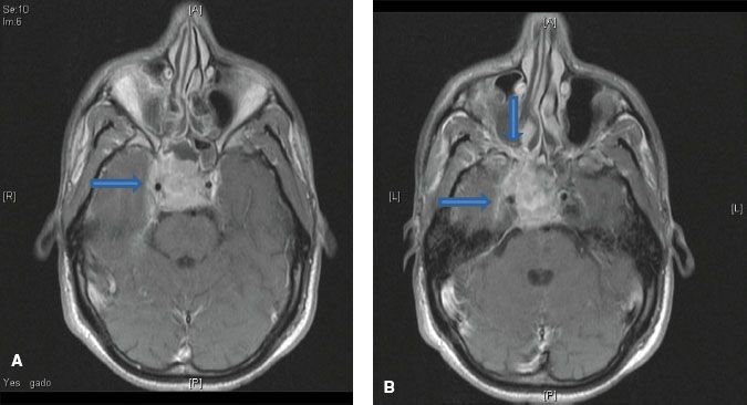 Nasopharynx | Oncohema Key