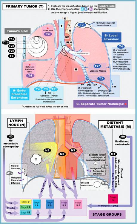 Stage 4 Adenocarcinoma Lung Cancer