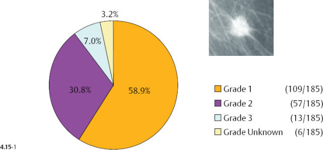 File:Pie chart of histopathologic types of invasive breast cancer