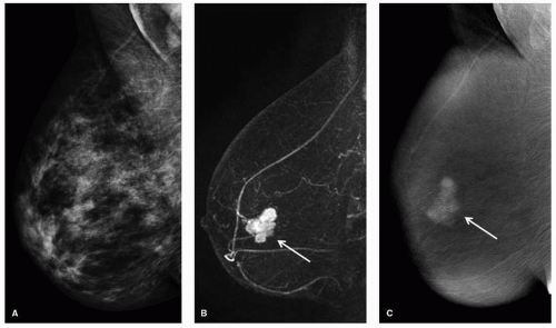 New Breast Imaging Techniques Oncohema Key