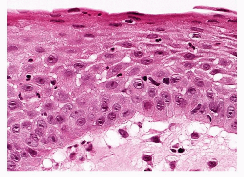 Bronchial Squamous Dysplasia and Carcinoma In Situ | Oncohema Key