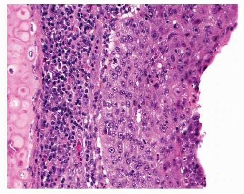 Severe Squamous Dysplasia Carcinoma In Situ