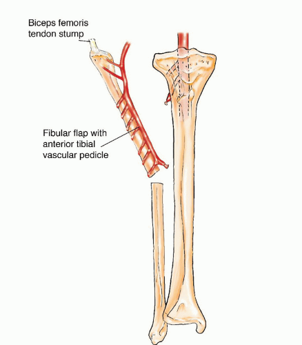 The Use of Free Vascularized Fibular Grafts for Reconstruction of