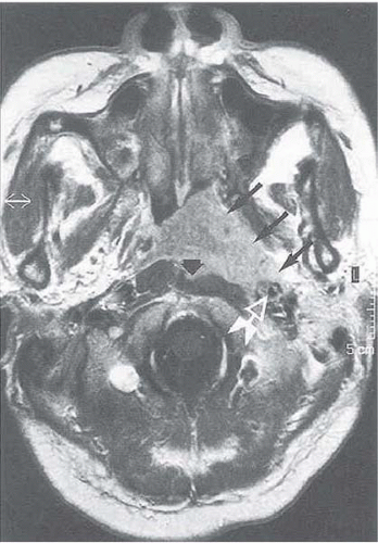 Nasopharynx Oncohema Key