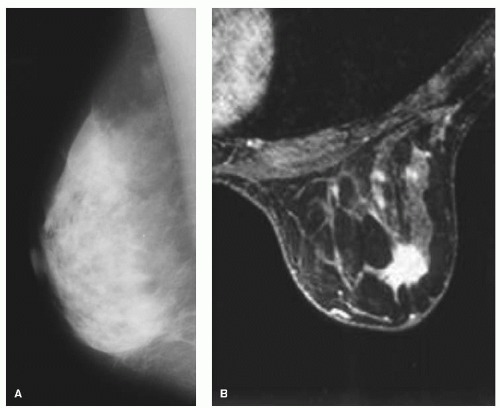 Repeat Lumpectomy Ipsilateral Breast Tumor Recurrence