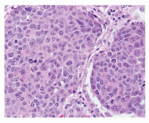 Large Cell Carcinoma | Oncohema Key
