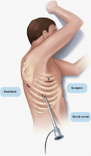 What Is Lung Resection Surgery