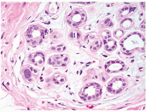 Pathology Of Benign Breast Disorders | Oncohema Key