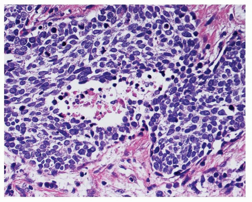Small Cell Carcinoma | Oncohema Key